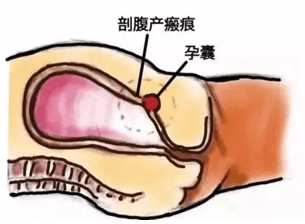 (一) 为什么特别讲到瘢痕子宫?