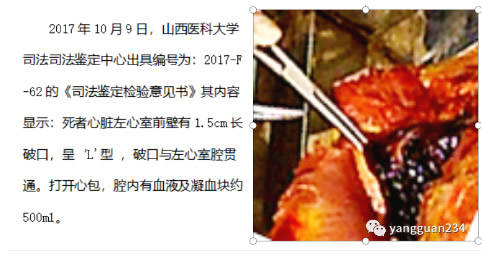 三,尸体解剖 死者不仅心脏破裂,心包填塞;而且右肩锁骨下方,胸大肌的