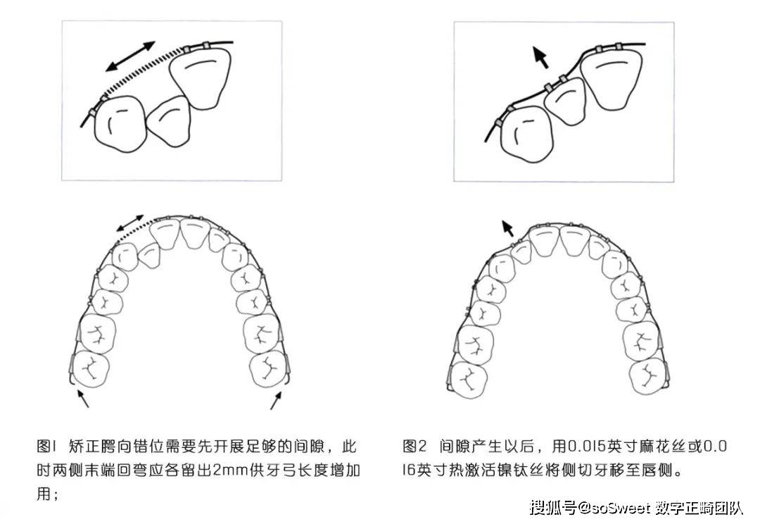 口腔正畸经验-上侧切牙腭向错位的便捷处理方法