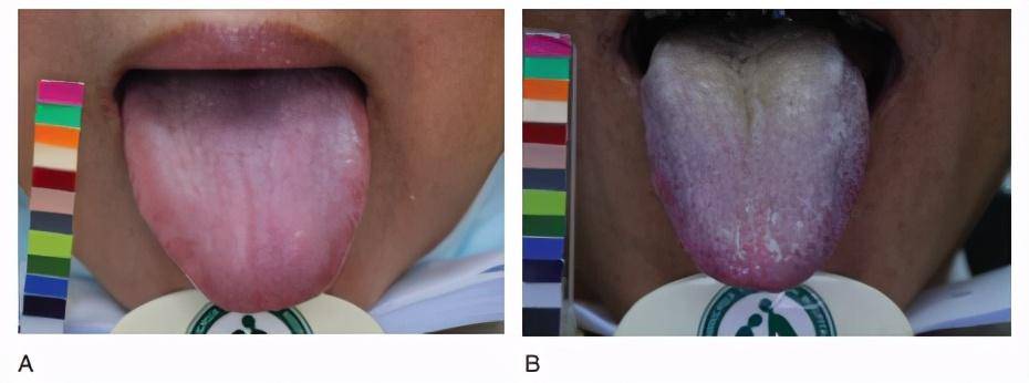 原创舌头这样子,可能是糖尿病了,快伸出来照镜子看看