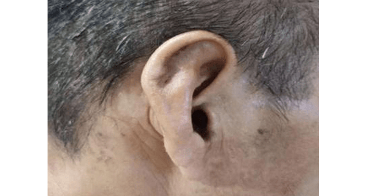 耳廓假性囊肿是什么?有危险吗?