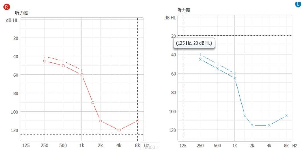 绵阳惠耳助听器案例专栏丨高频陡降听力该怎么办?