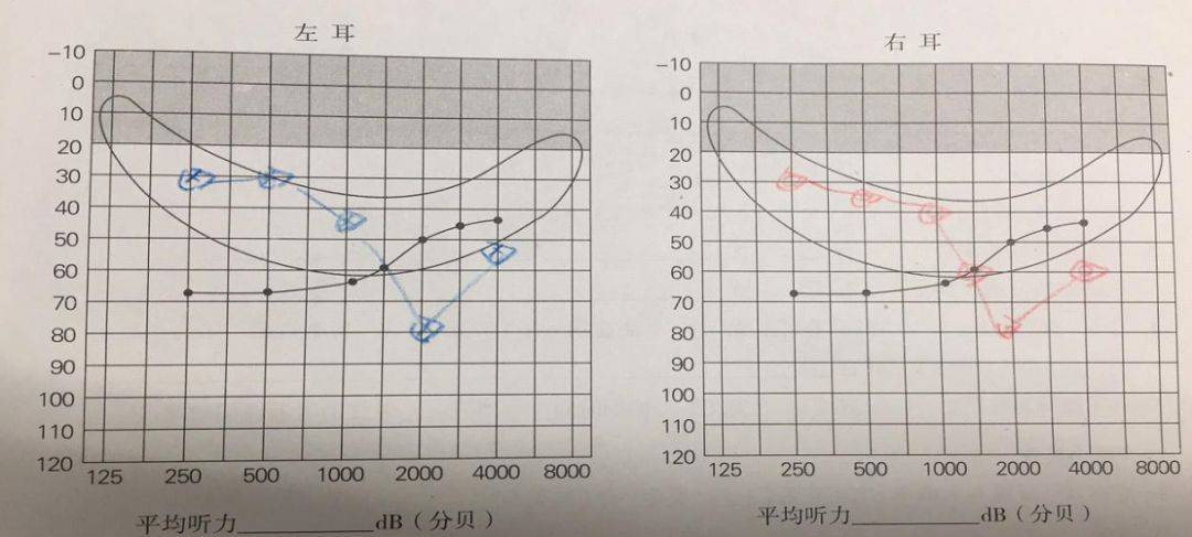 绵阳惠耳助听器案例专栏丨高频陡降听力该怎么办?