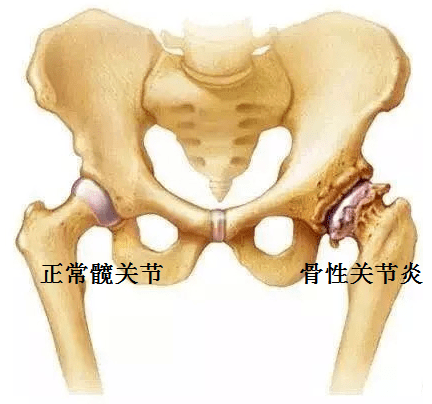 老年人髋关节疼痛,走路跛行,警惕髋关节骨性关节炎