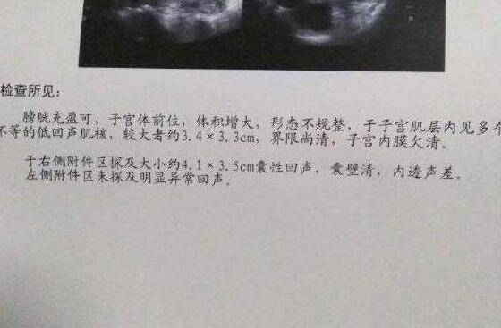 唠唠子宫肌瘤巧克力囊肿让人心塞的那段日子