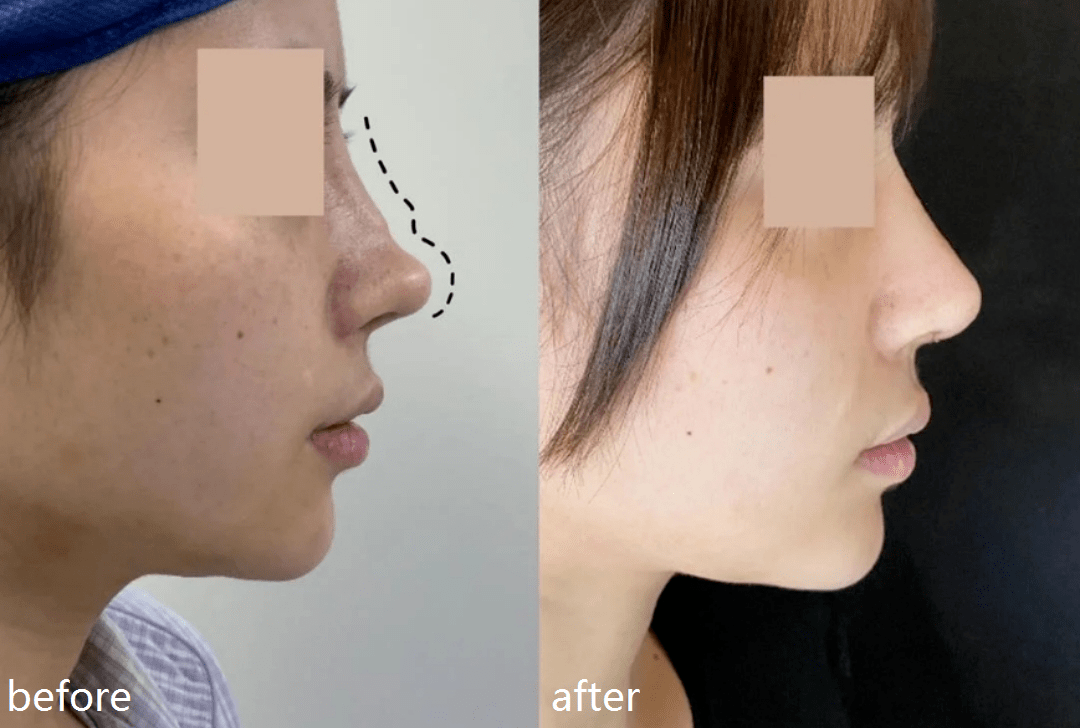 土豆|自己整成馒头脸,还教粉丝瞎整,她这不是第一次翻车了…