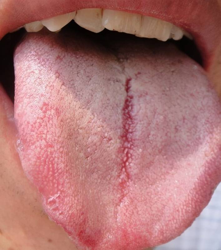正常舌苔不干不湿,无苔干燥为体内津液已耗,外感病多为燥热伤津,内伤