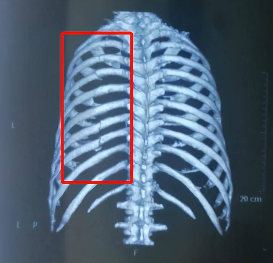 摔一跤,折7根肋骨,医生凭什么让患者回家了?真的不需要治疗吗