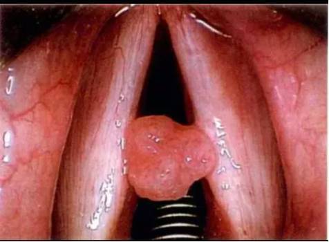 躺下感觉喉咙有异物感想吐 c0a7c163445c4b6d9a99984b31439e82.jpeg