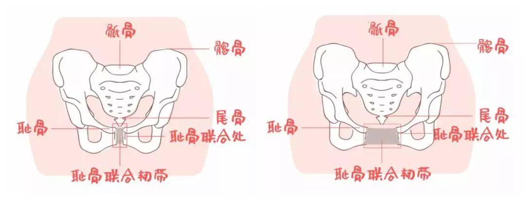 产后无论做不做骨盆修复,大部分人一到三个月内会自动恢复