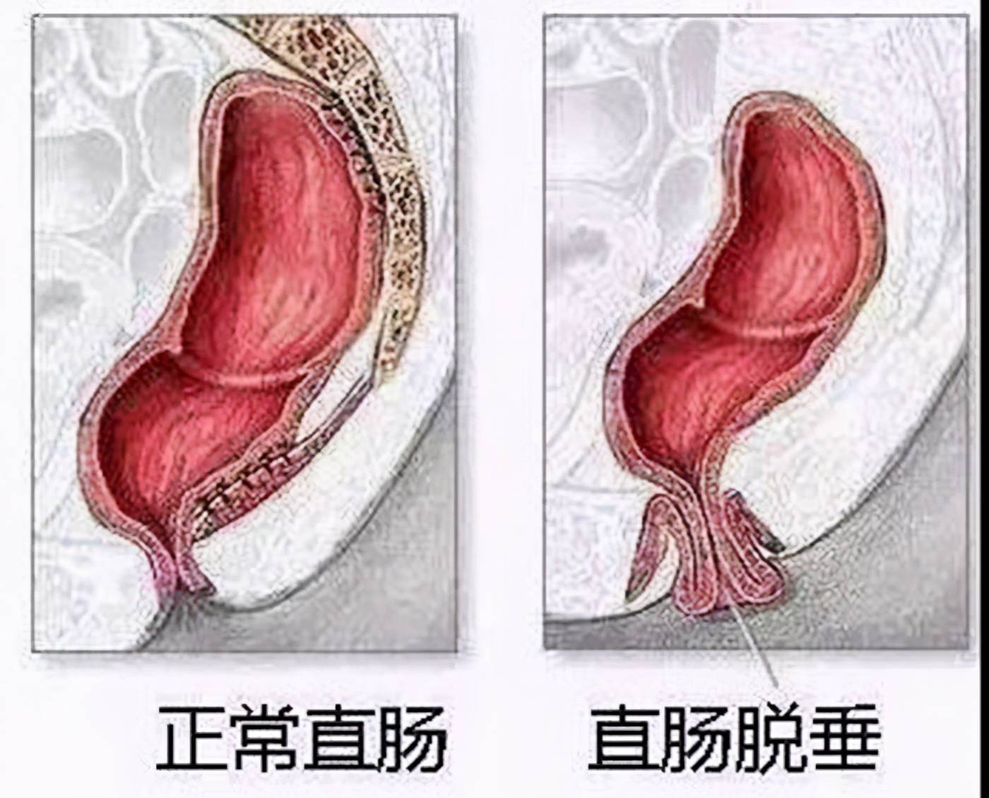 直肠脱垂怎么办