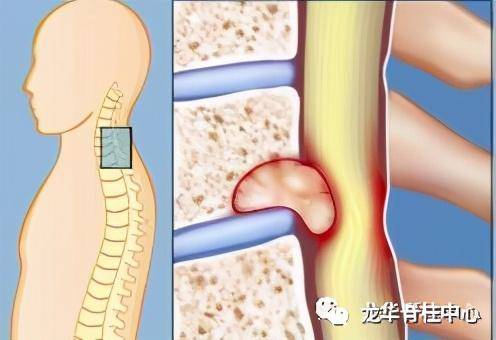颈椎肿瘤