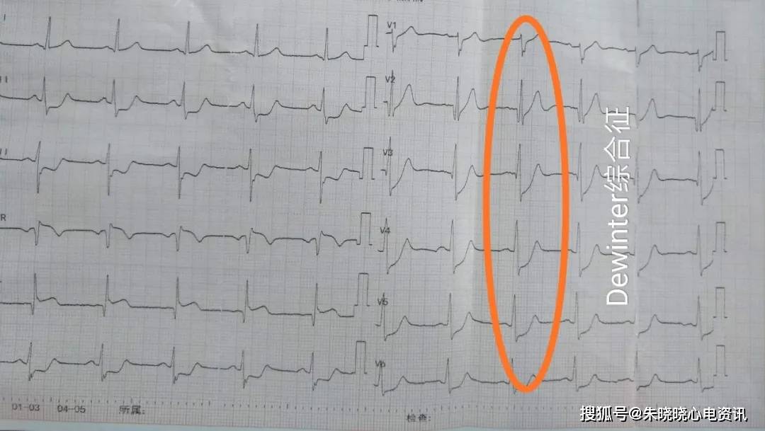 心梗只知道st段抬高这4种高危心电图你不可不知