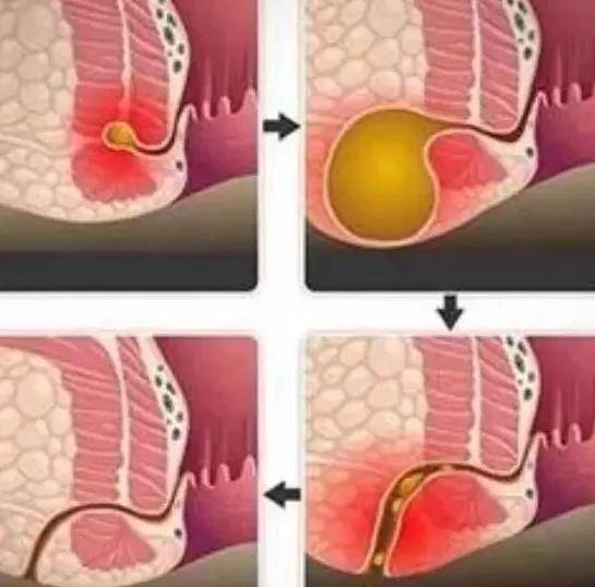 肛周脓肿是肛管直肠间隙发生急,慢性感染而形成的脓肿.