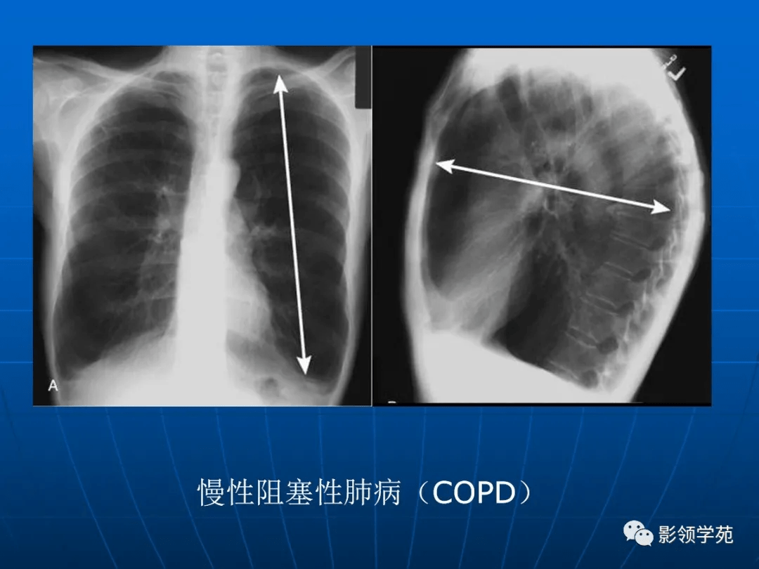 肺气肿的影像诊断