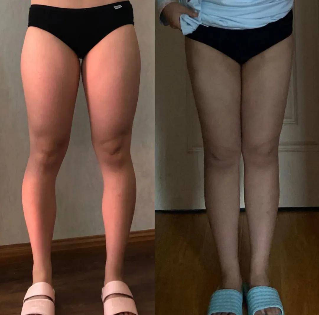 手术|杨幂关晓彤杠上了？撞衫尴尬就算了，还被网友喷做了直腿手术…