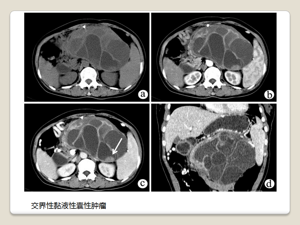 胰腺常见囊性肿瘤的ct表现及鉴别诊断