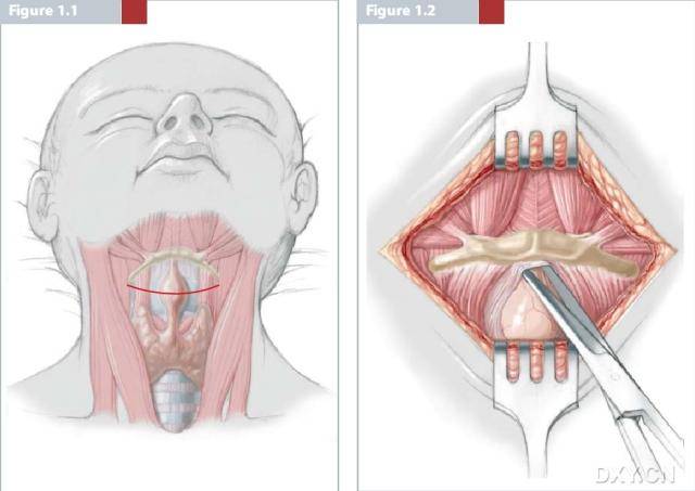 甲状舌管囊肿由于囊肿及瘘管同舌骨体的密切关系,手术时应切除与之