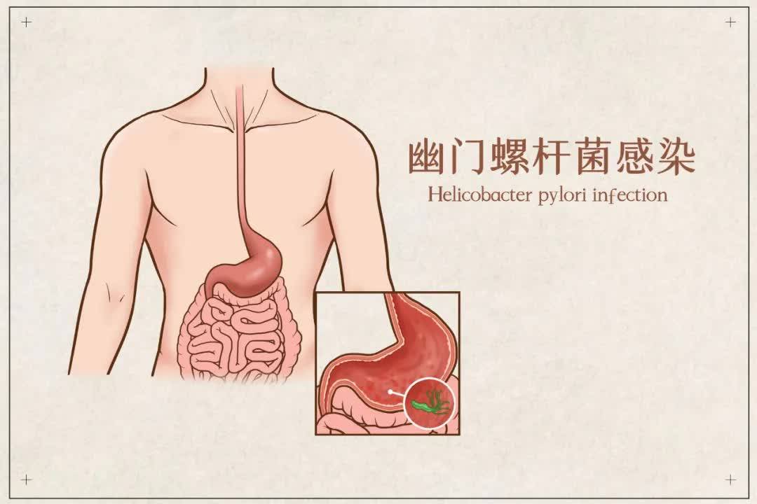 没有症状也有治疗幽门螺杆菌感染药知道