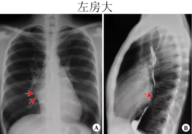 x线中的心影增大,怎么解读?