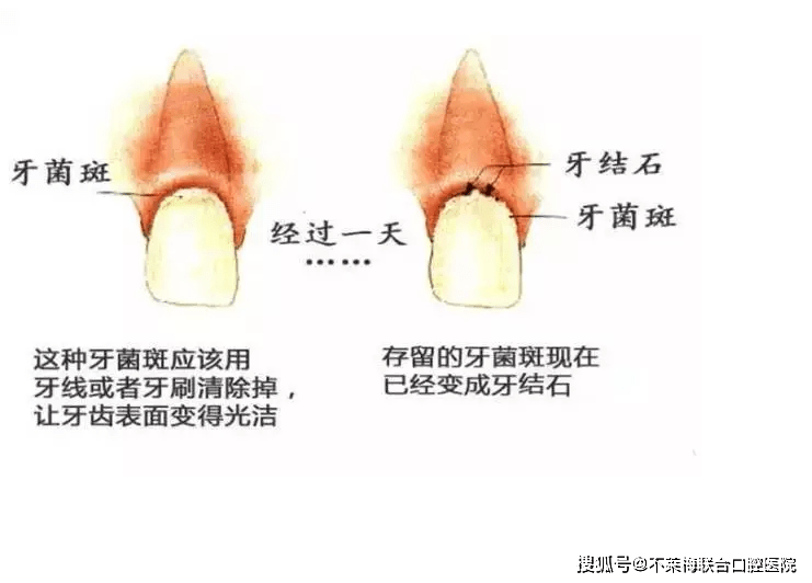 如何刷牙不损伤牙龈 0f65aaf81f30440c87ef80cf47199883.png