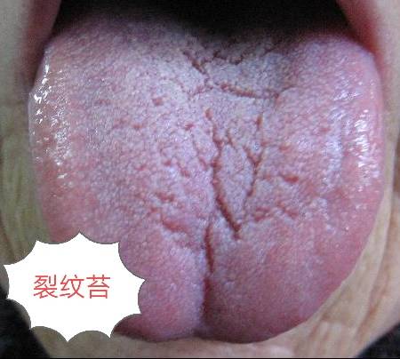 从舌头看健康,看看你是哪种问题舌!_舌苔