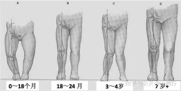 腰长加o型腿怎么搭_o型腿图片(2)