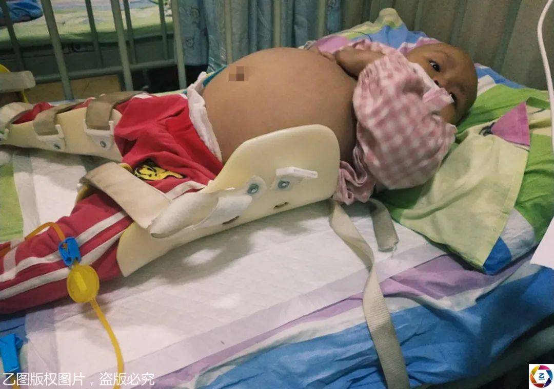 怪物|大如气球，妈妈心痛却束手无策四川2岁小萝莉肚里长“怪物”