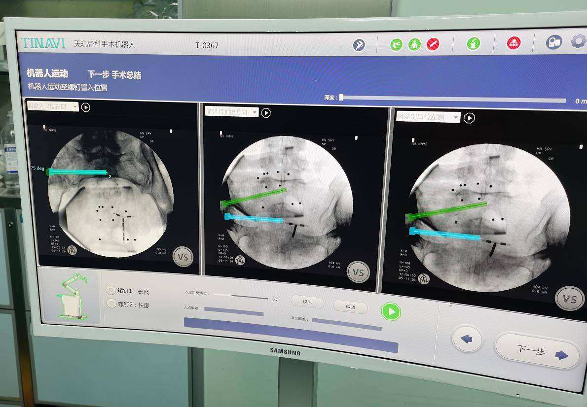手术|河南首例！河南省医成功完成机器人引导下创伤骨科高难度复杂手术
