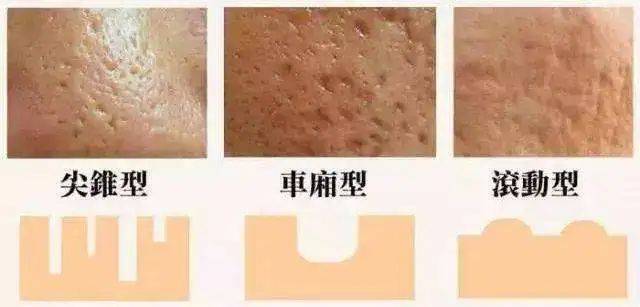 脸上的痘坑怎么弄平 3c393cc390244165bc787043e0f9ed9d.jpeg