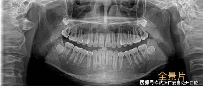 牙齿矫正前为啥要拍片