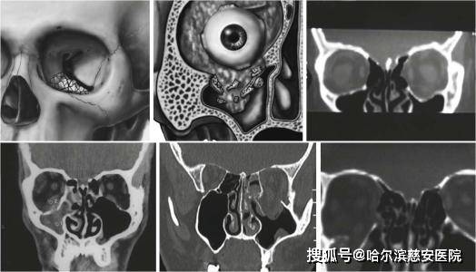 【科普】爆裂性眼眶骨折_手机搜狐网