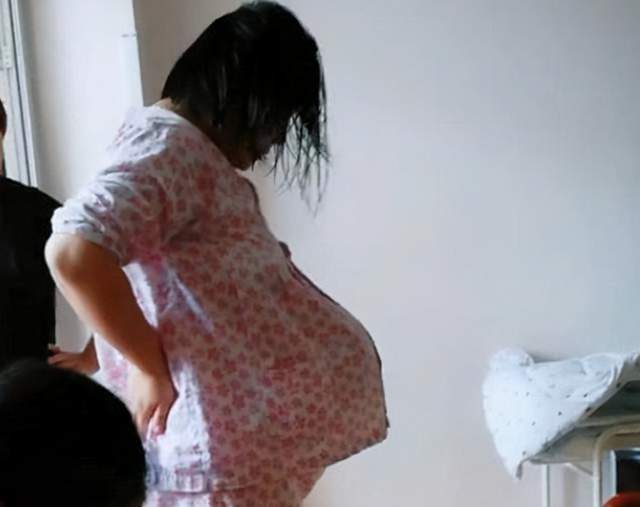 悬浮肚会导致产妇行动困难 如果产妇是"悬浮肚"的话,肚子越大,产妇