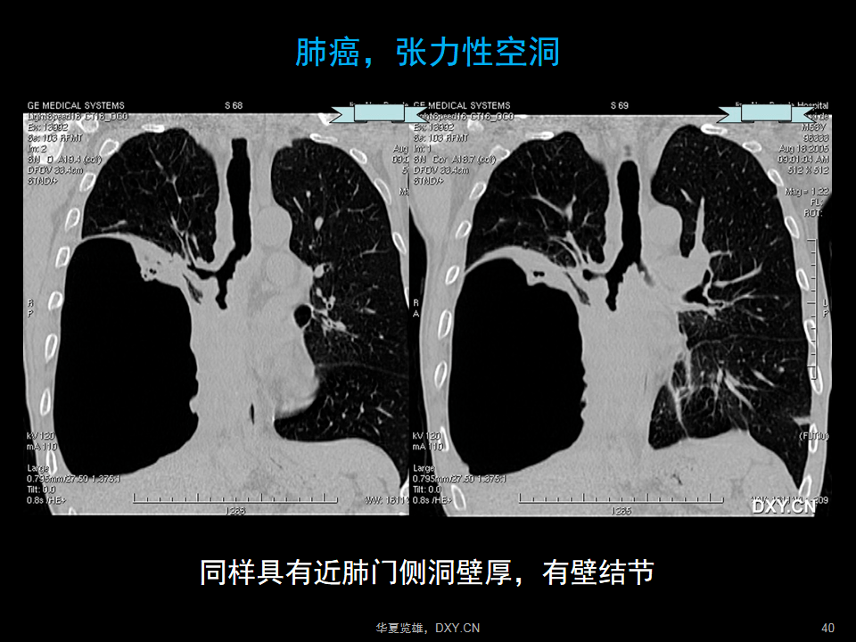 肺炎症,结核,肿瘤在ct及胸片上有哪些区别?