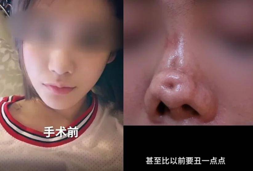 假体全部取出,而鼻子也直接变成了畸形,不仅正面凹陷,还变成了朝天鼻