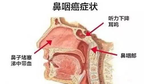 贵阳铭仁耳鼻喉医院披着鼻炎外衣的鼻咽癌要警惕你要注意这些症状