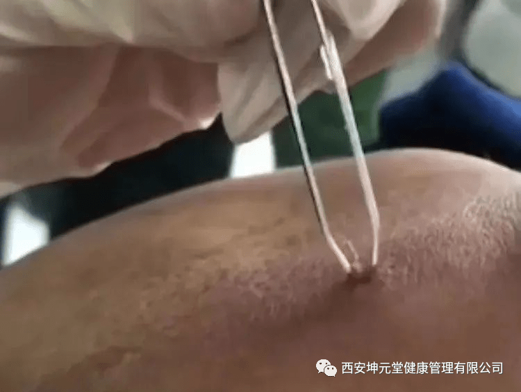 中医讲堂:神奇的截根术治疗痔疮 — 你知道吗?