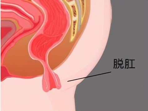 脱肠怎么办