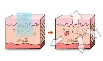 【知识科普】激光美容知识大展示_治疗