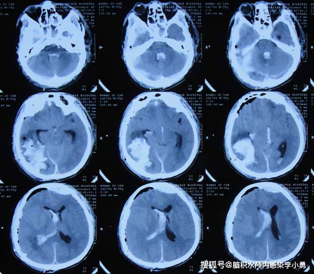 脑外伤性脑积水术后再行小脑扁桃体下疝切除术致颅内感染外院治3月