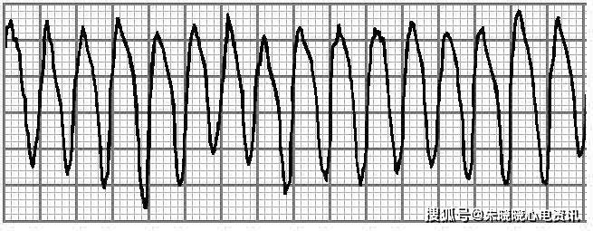 趣谈心电图的快慢步伐