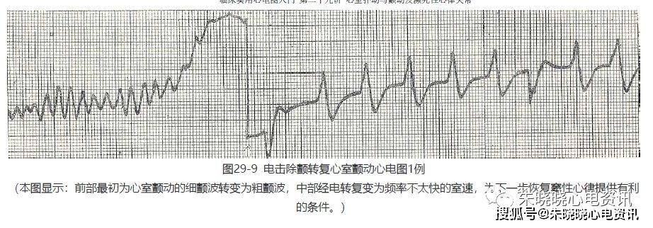 心室扑动与颤动及濒死性心律失常_心电图