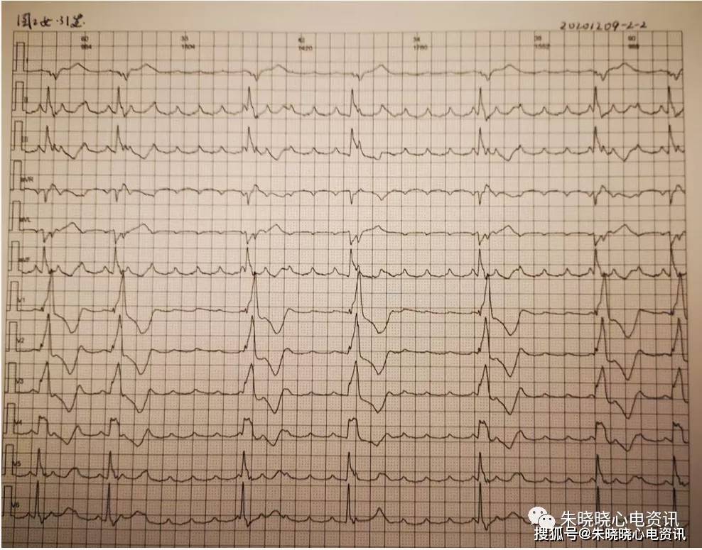 卢老师看心电图-- 持续性房性心动过速伴特宽型完全性