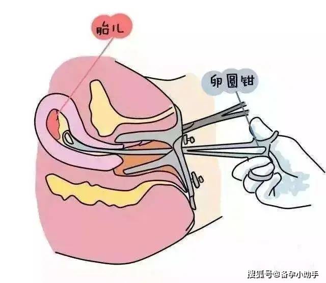 女性输卵管堵塞,跟男人有什么关系吗?