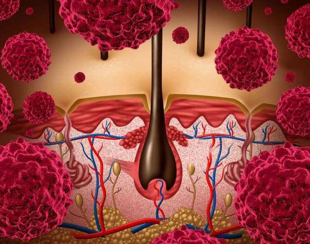 癌细胞光临时,皮肤出现四"症状"