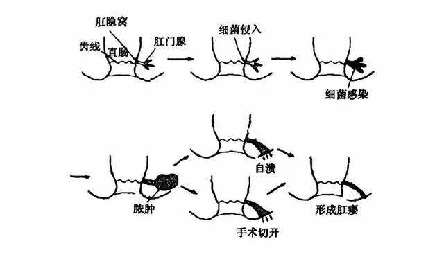 肛周脓肿十问十答