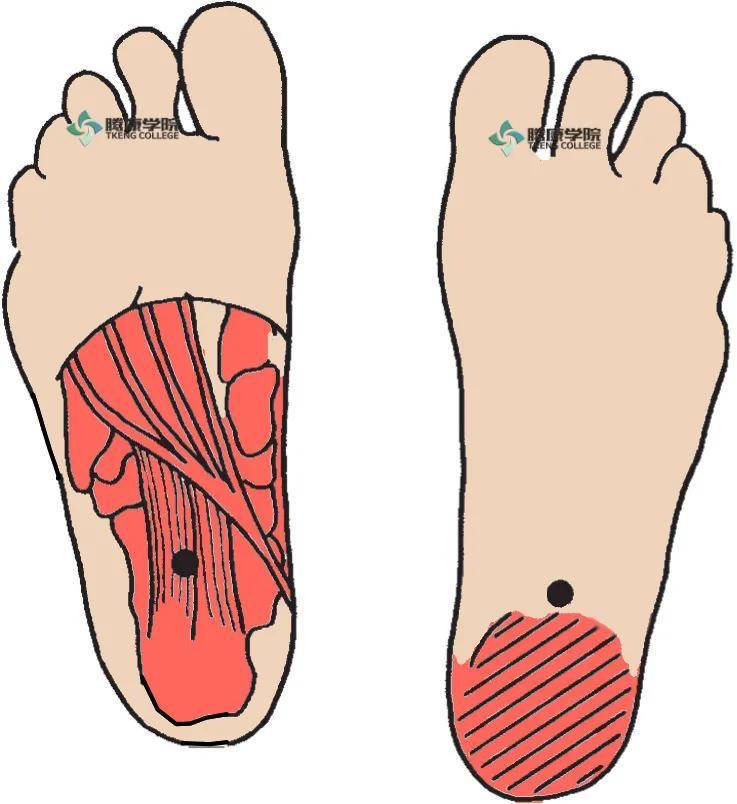 足底方肌扳机点会引起足跟刺痛,这种疼痛像踩在石头上被擦伤的感觉.