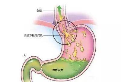 2,胆汁反流