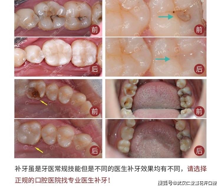 补牙大解惑这几点你不知道就亏了