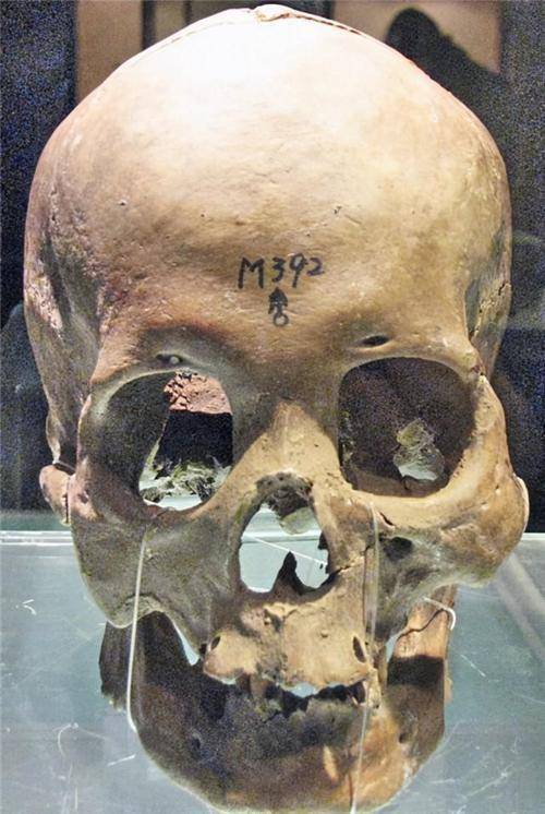 5000年前的头颅因开了个洞,证明开颅手术的存在,手术还很成功